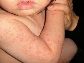 Symptoms of Sepsis in Babies and Kids: What Every Parent Needs to Know 1 Sepsis Symptoms in Babies and Kids: What Every Parent Needs to Know